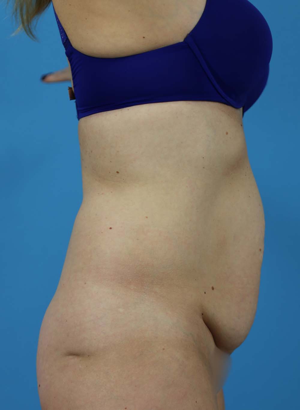 Liposuction Before and After | Dr Evan W Beale