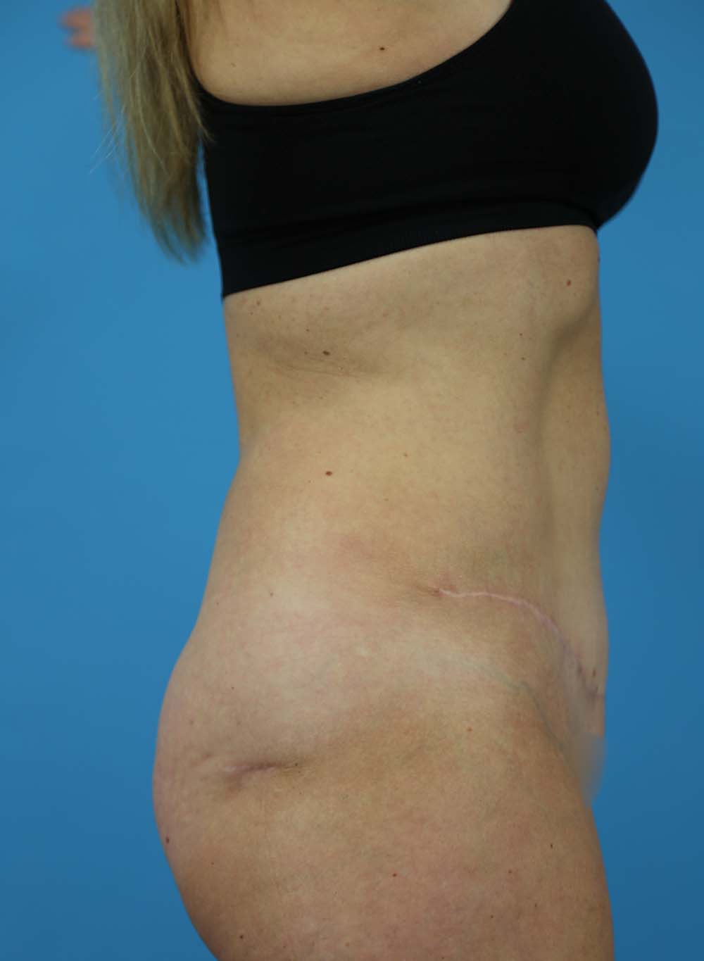 Liposuction Before and After | Dr Evan W Beale