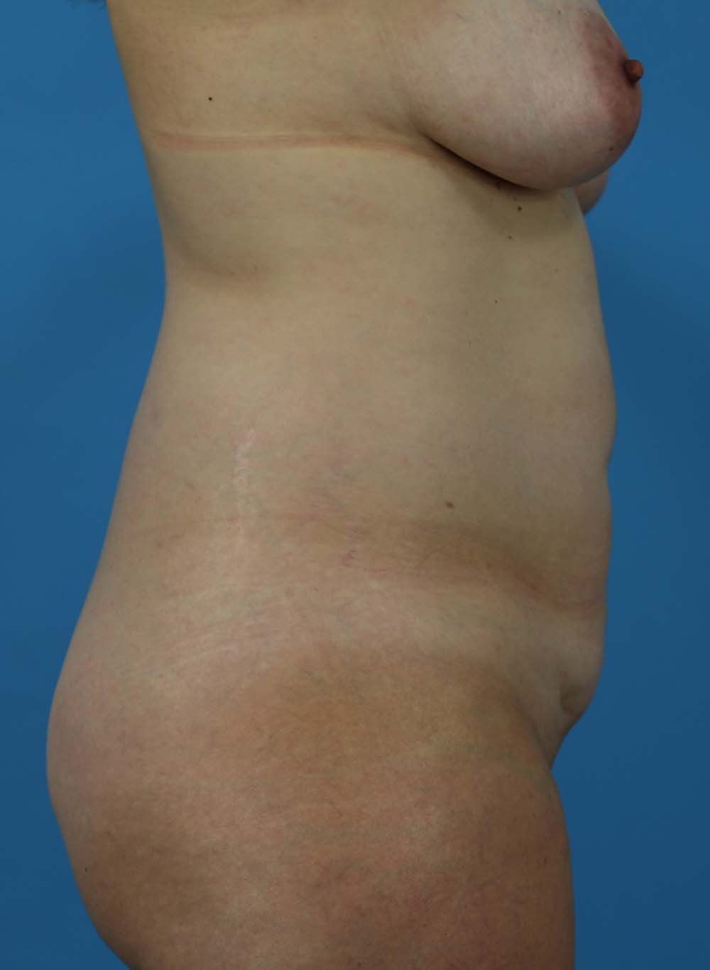 Liposuction Before and After | Dr Evan W Beale
