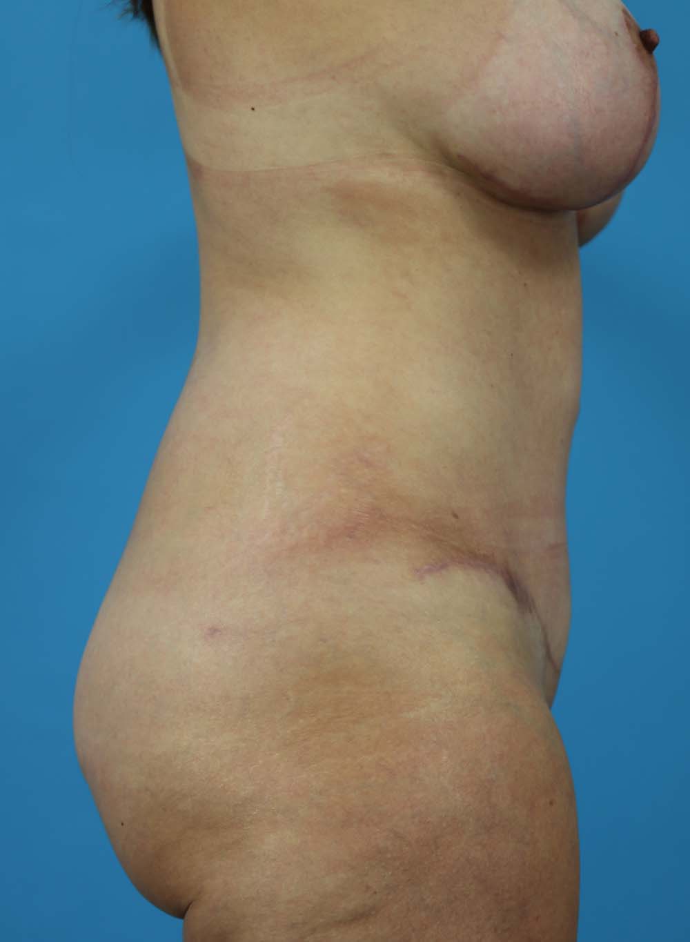 Liposuction Before and After | Dr Evan W Beale