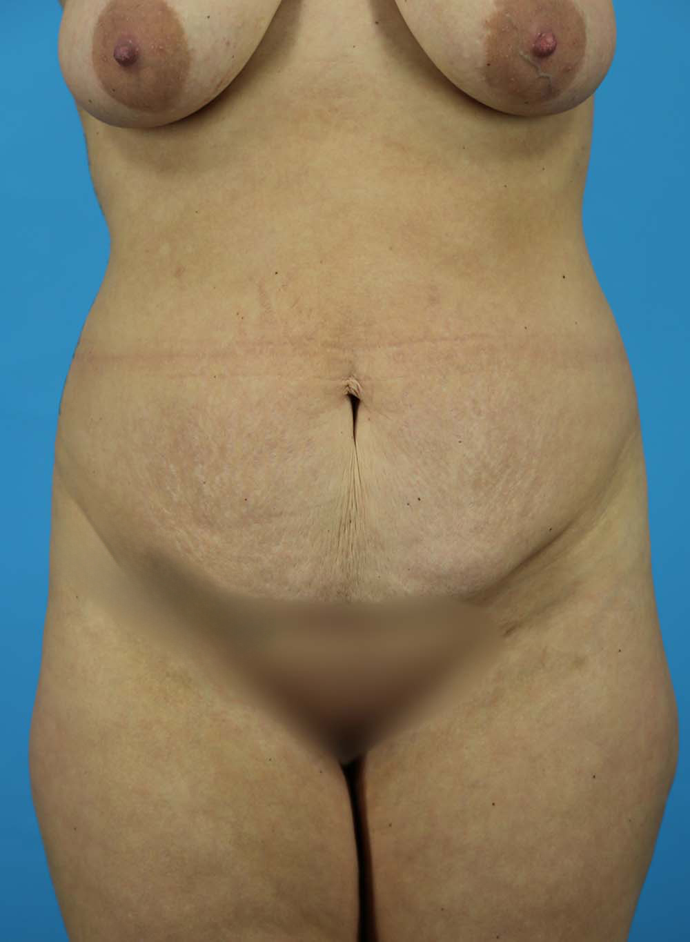 Liposuction Before and After | Dr Evan W Beale