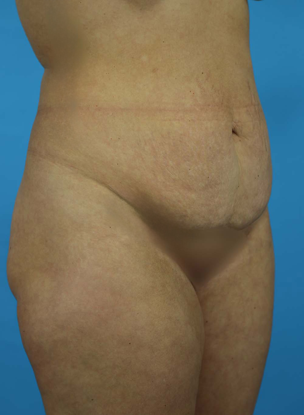 Liposuction Before and After | Dr Evan W Beale