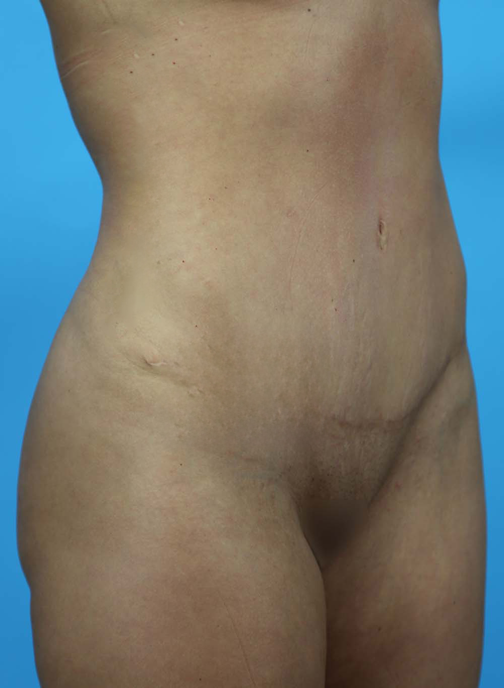 Liposuction Before and After | Dr Evan W Beale