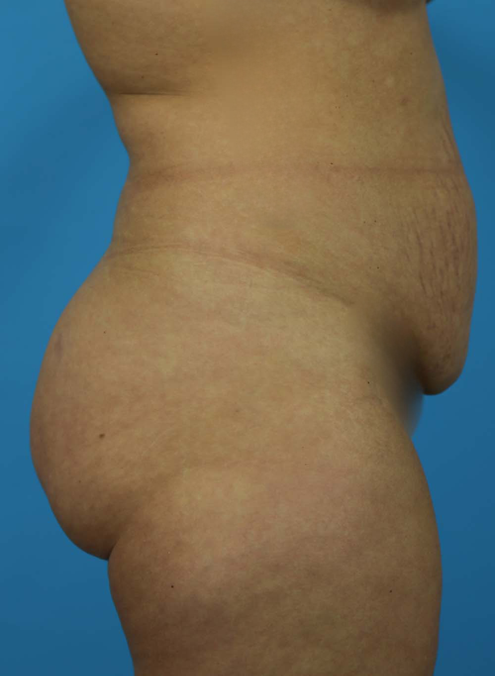 Liposuction Before and After | Dr Evan W Beale
