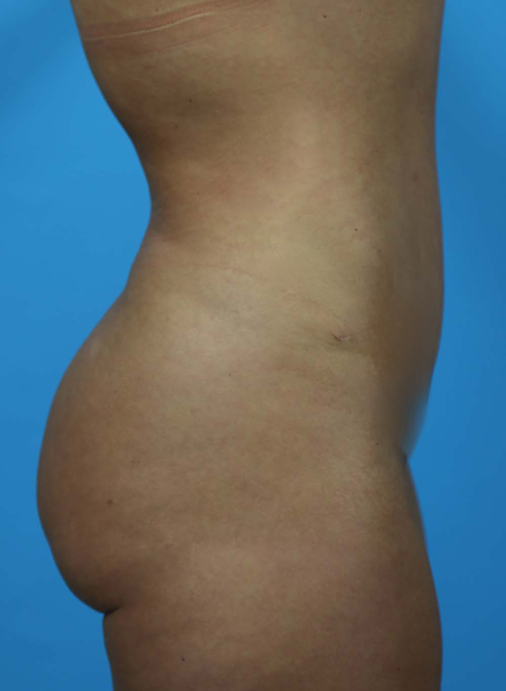 Liposuction Before and After | Dr Evan W Beale