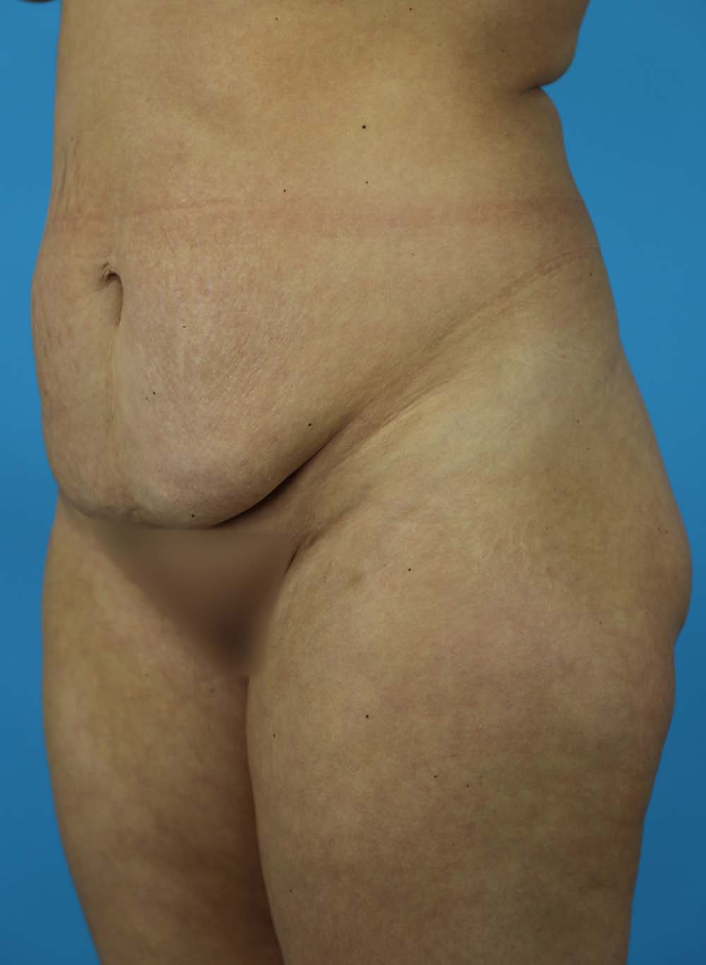 Liposuction Before and After | Dr Evan W Beale