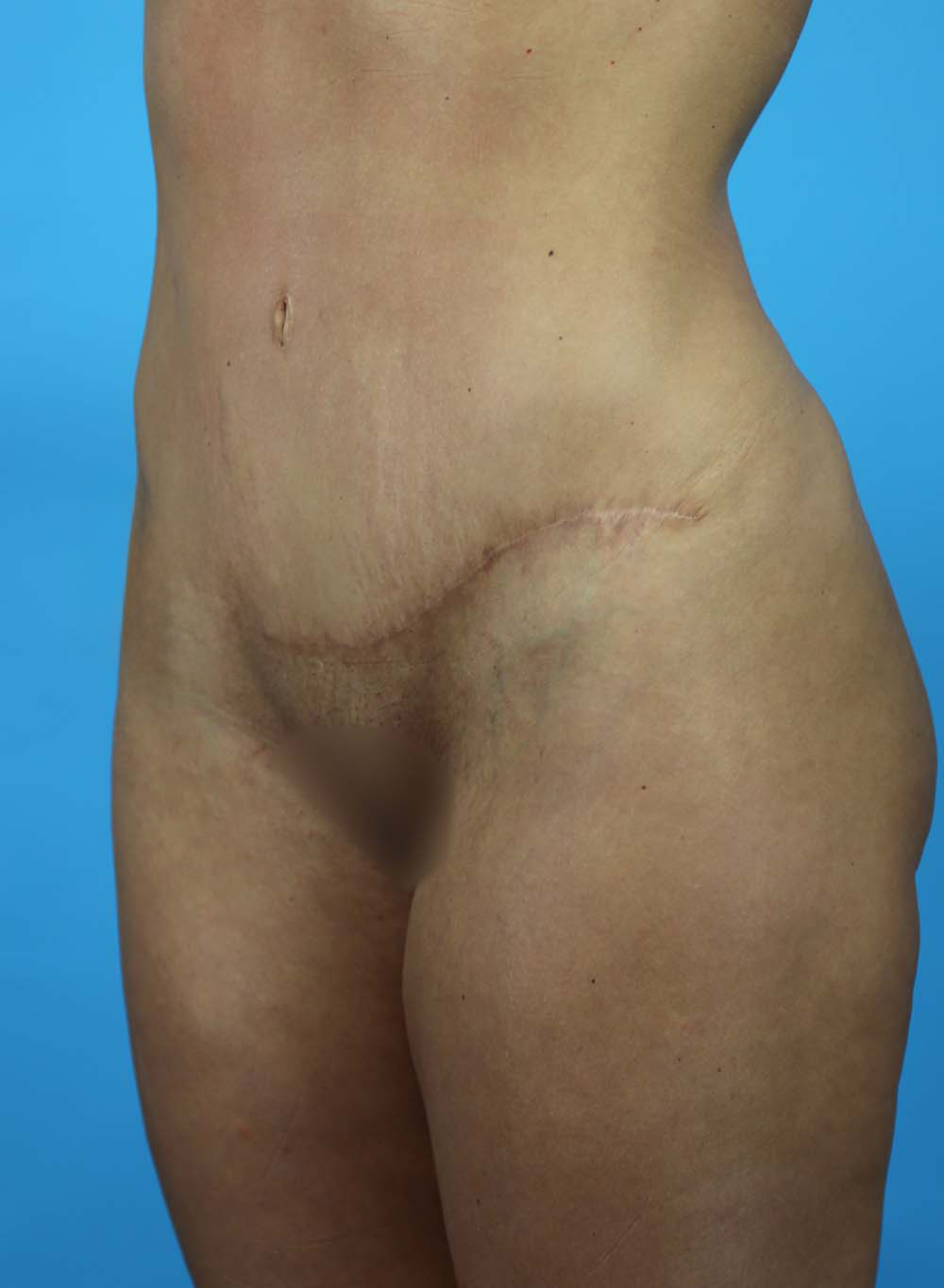Liposuction Before and After | Dr Evan W Beale