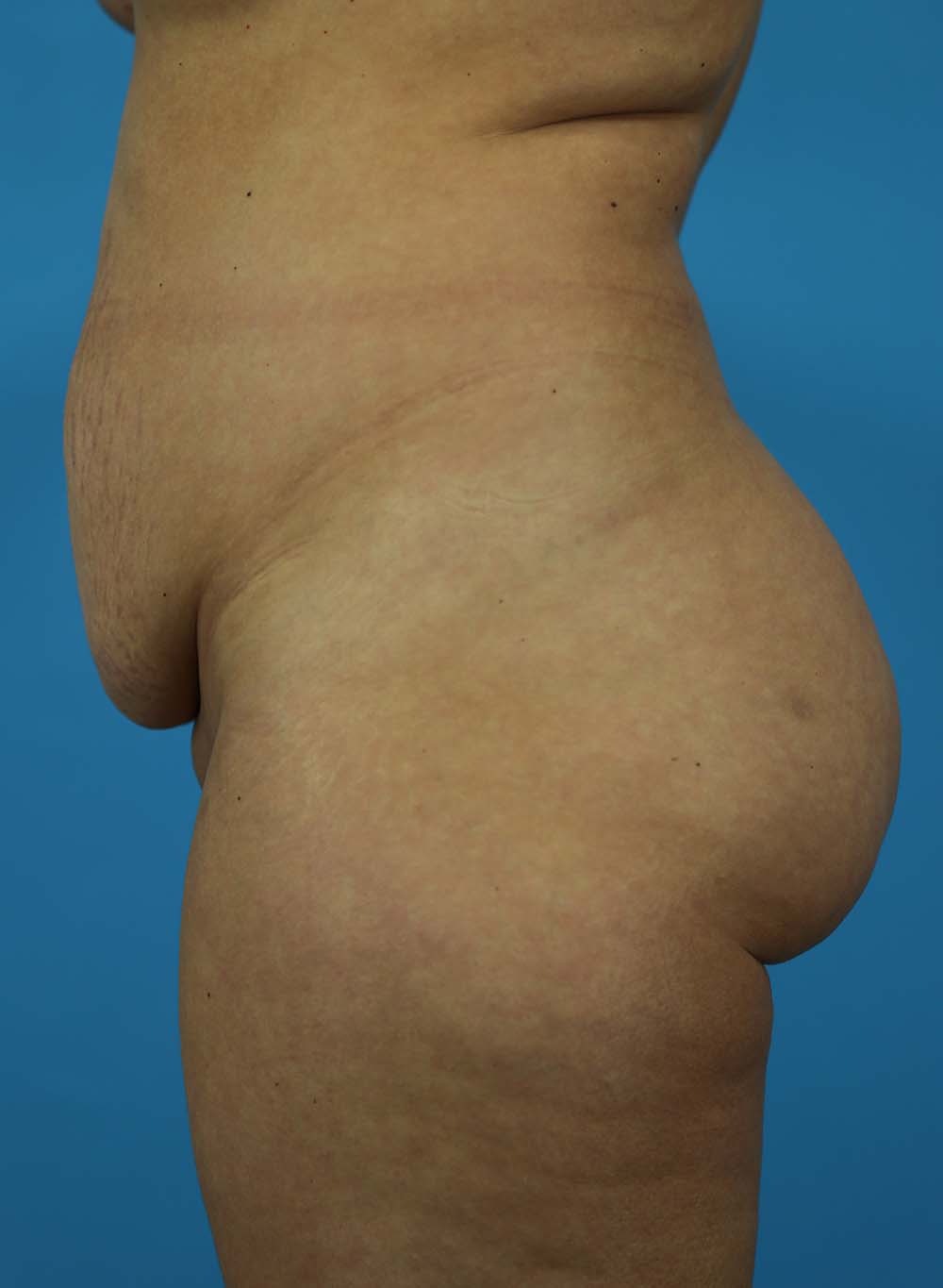 Liposuction Before and After | Dr Evan W Beale