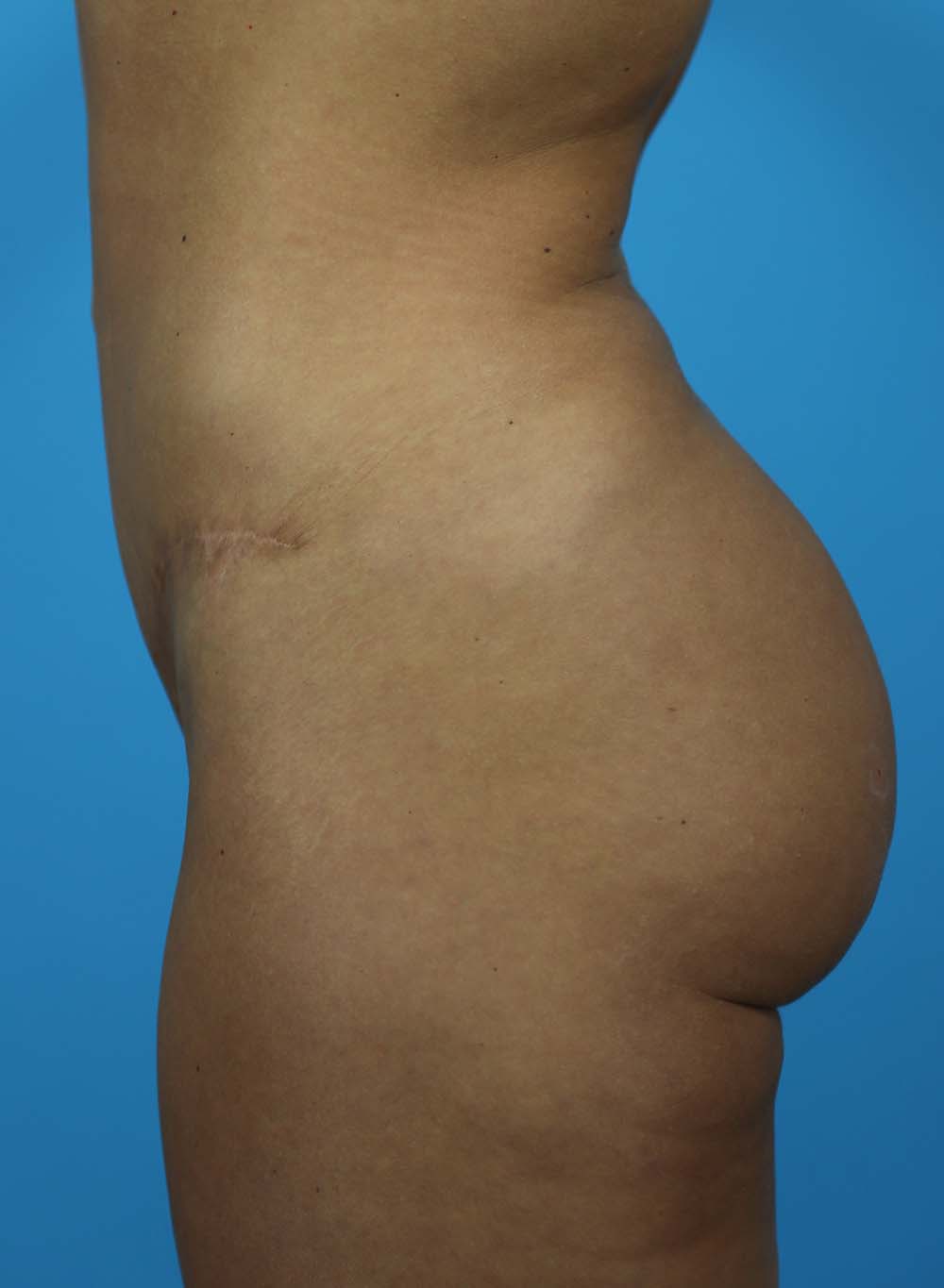 Liposuction Before and After | Dr Evan W Beale