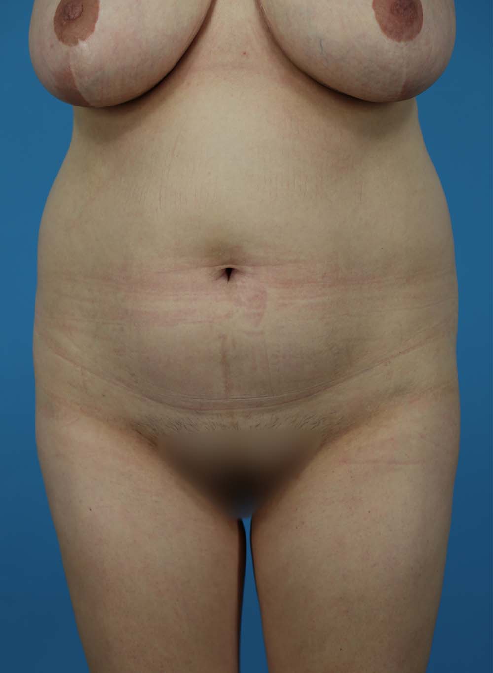 Liposuction Before and After | Dr Evan W Beale