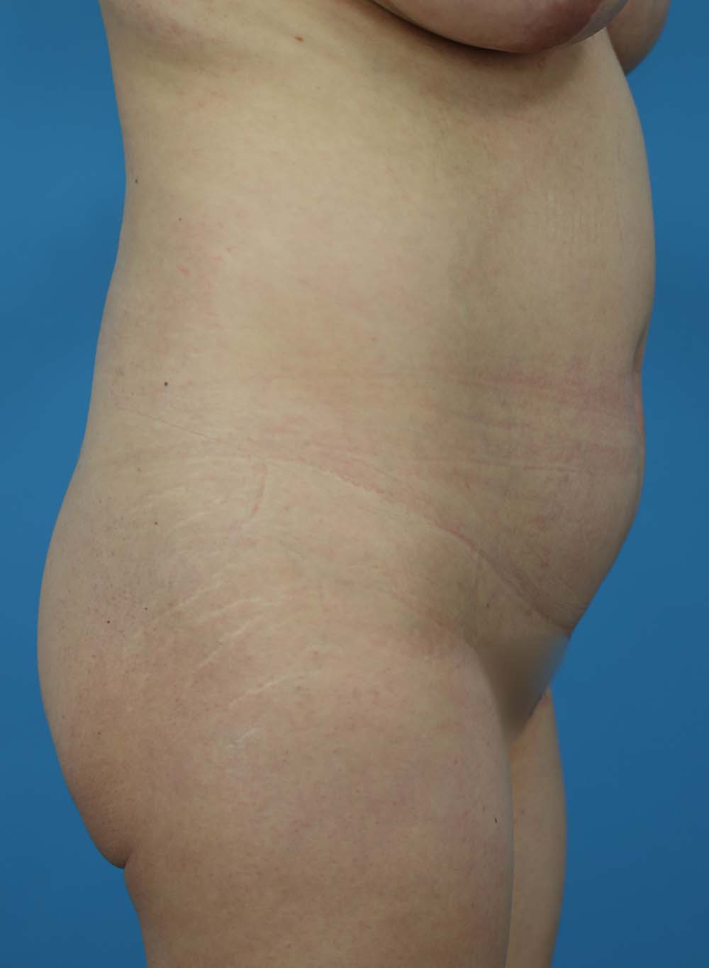 Liposuction Before and After | Dr Evan W Beale