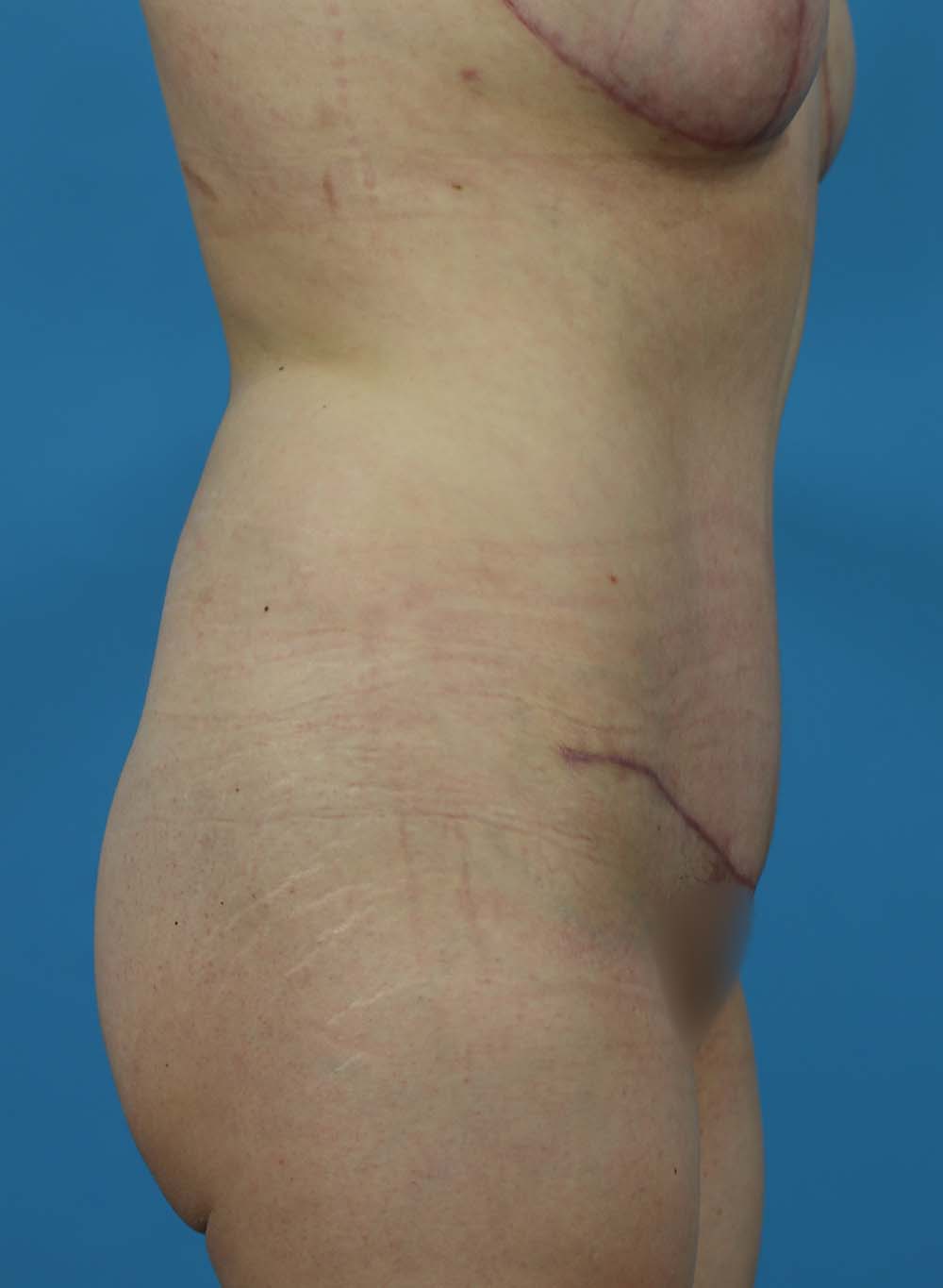 Liposuction Before and After | Dr Evan W Beale