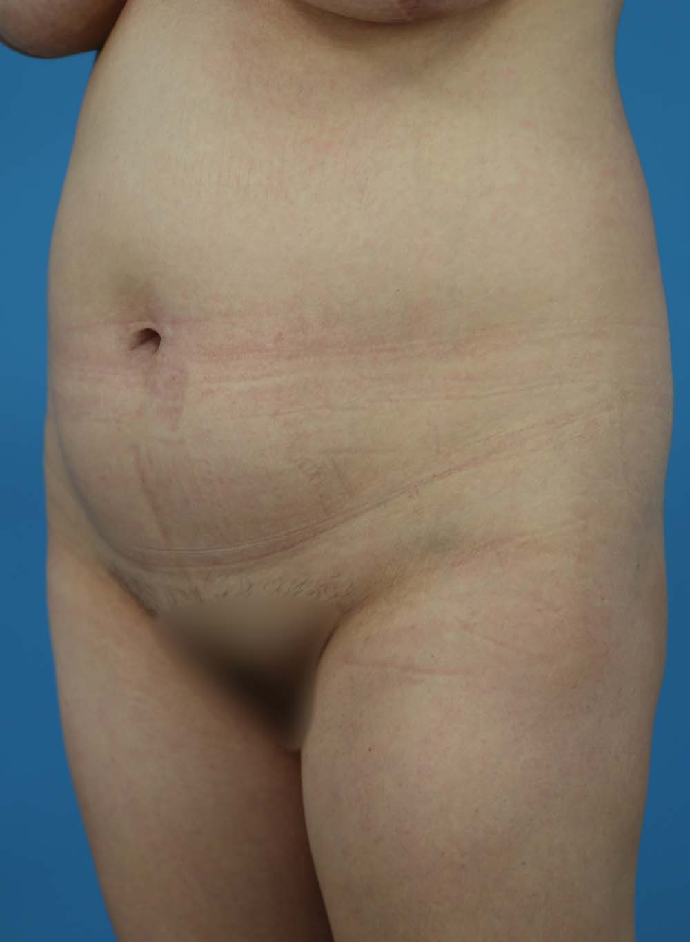 Liposuction Before and After | Dr Evan W Beale