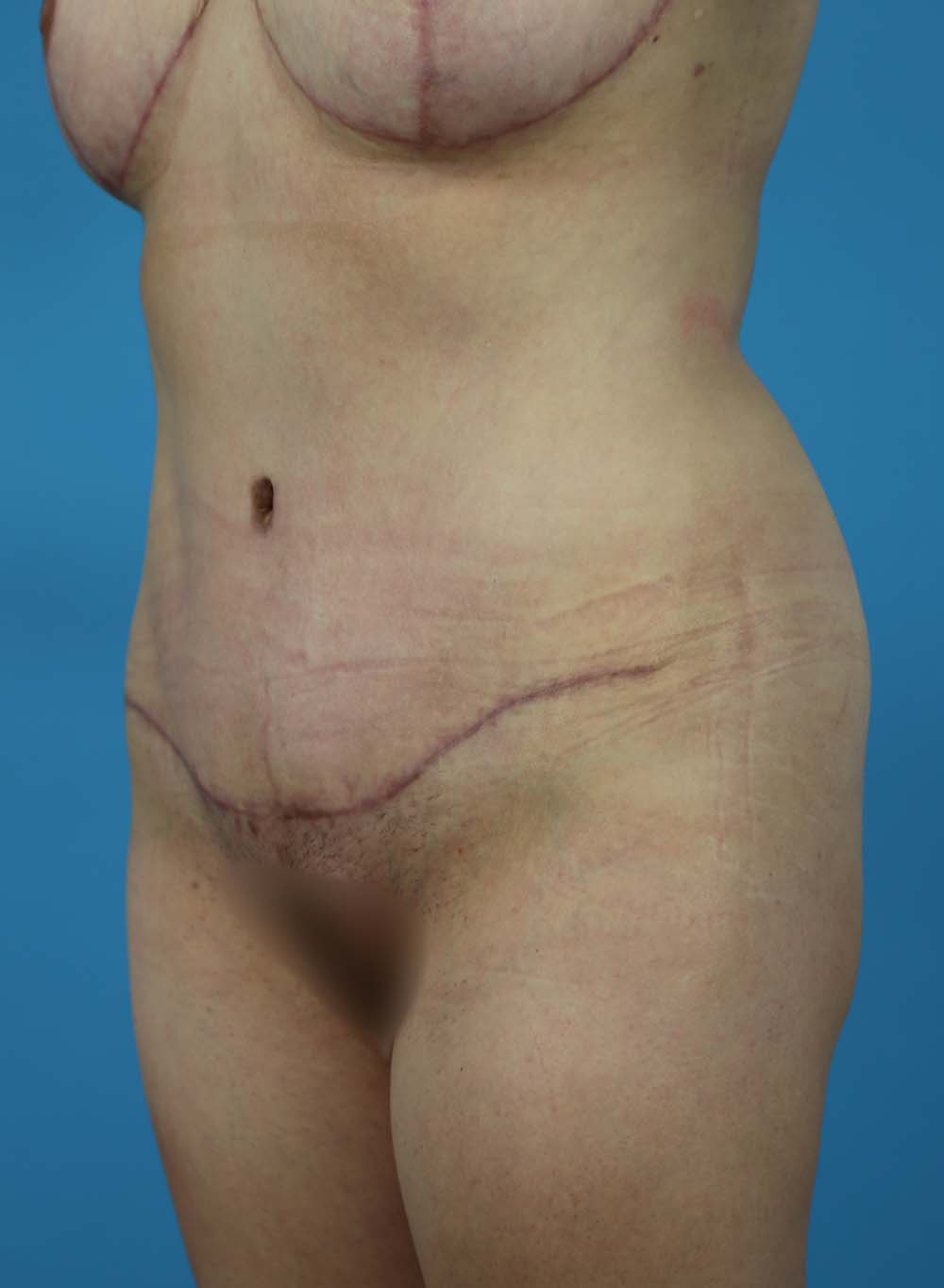 Liposuction Before and After | Dr Evan W Beale
