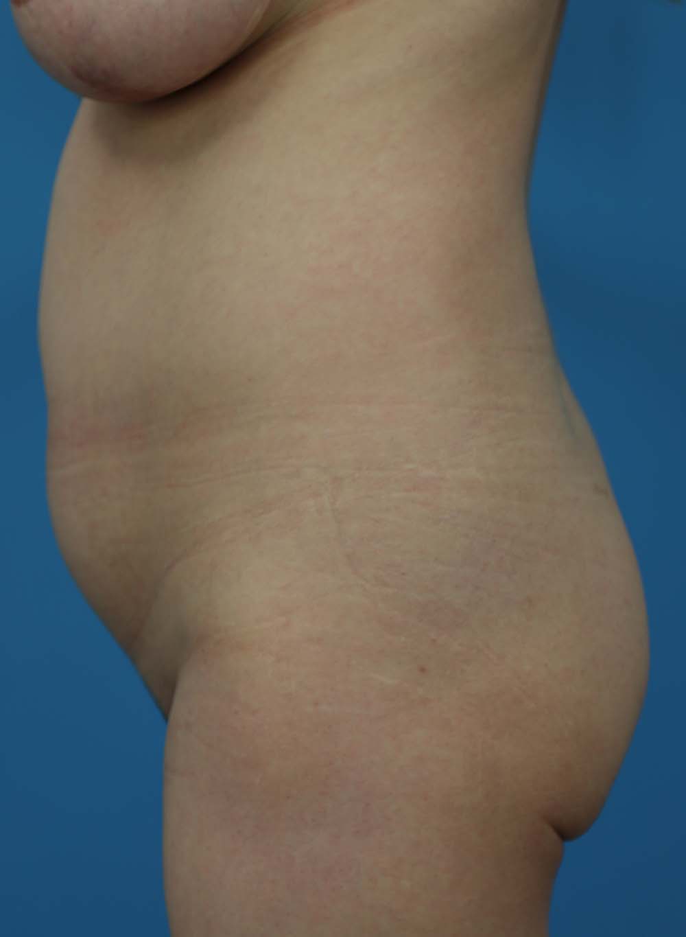 Liposuction Before and After | Dr Evan W Beale
