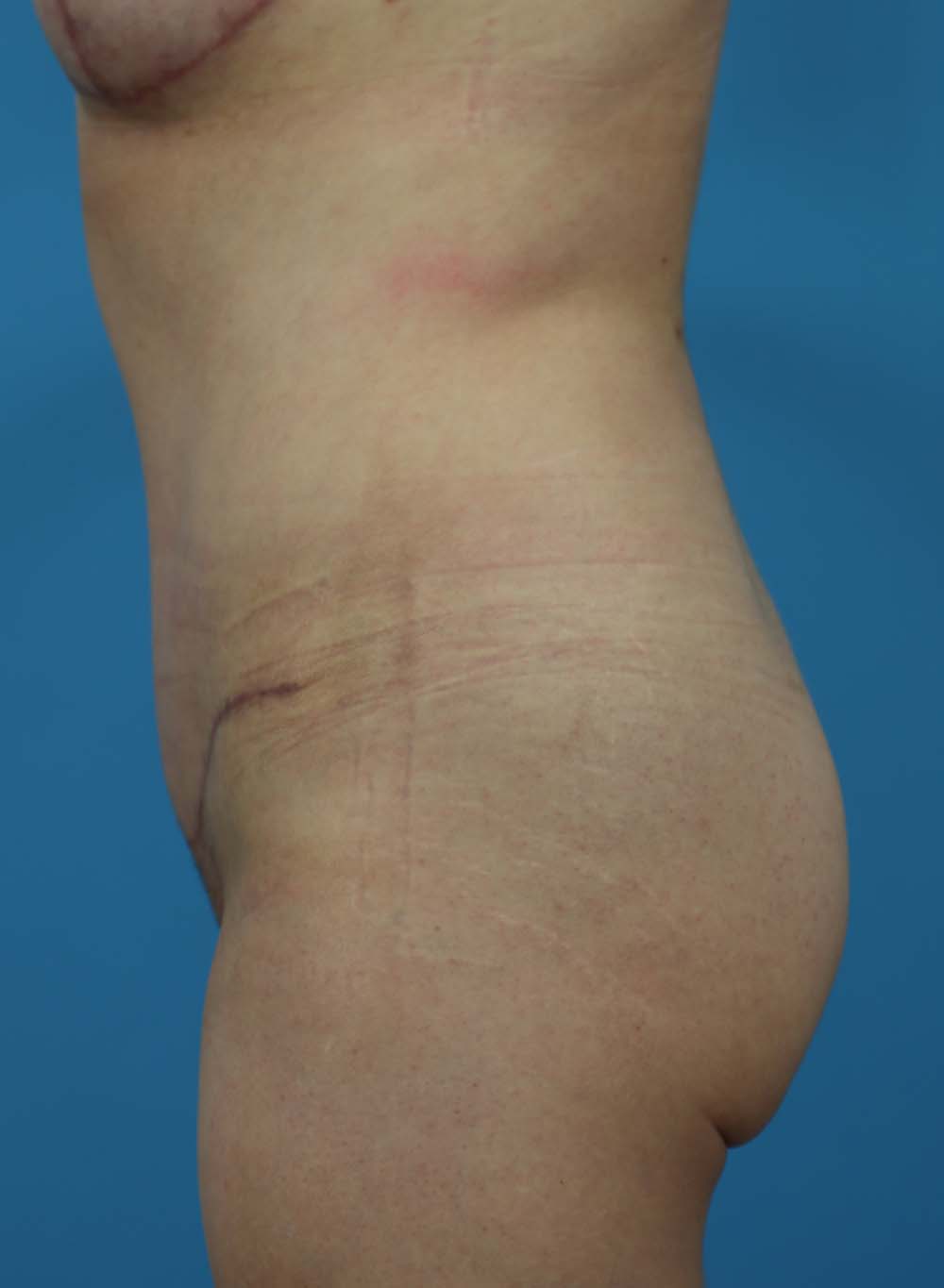 Liposuction Before and After | Dr Evan W Beale
