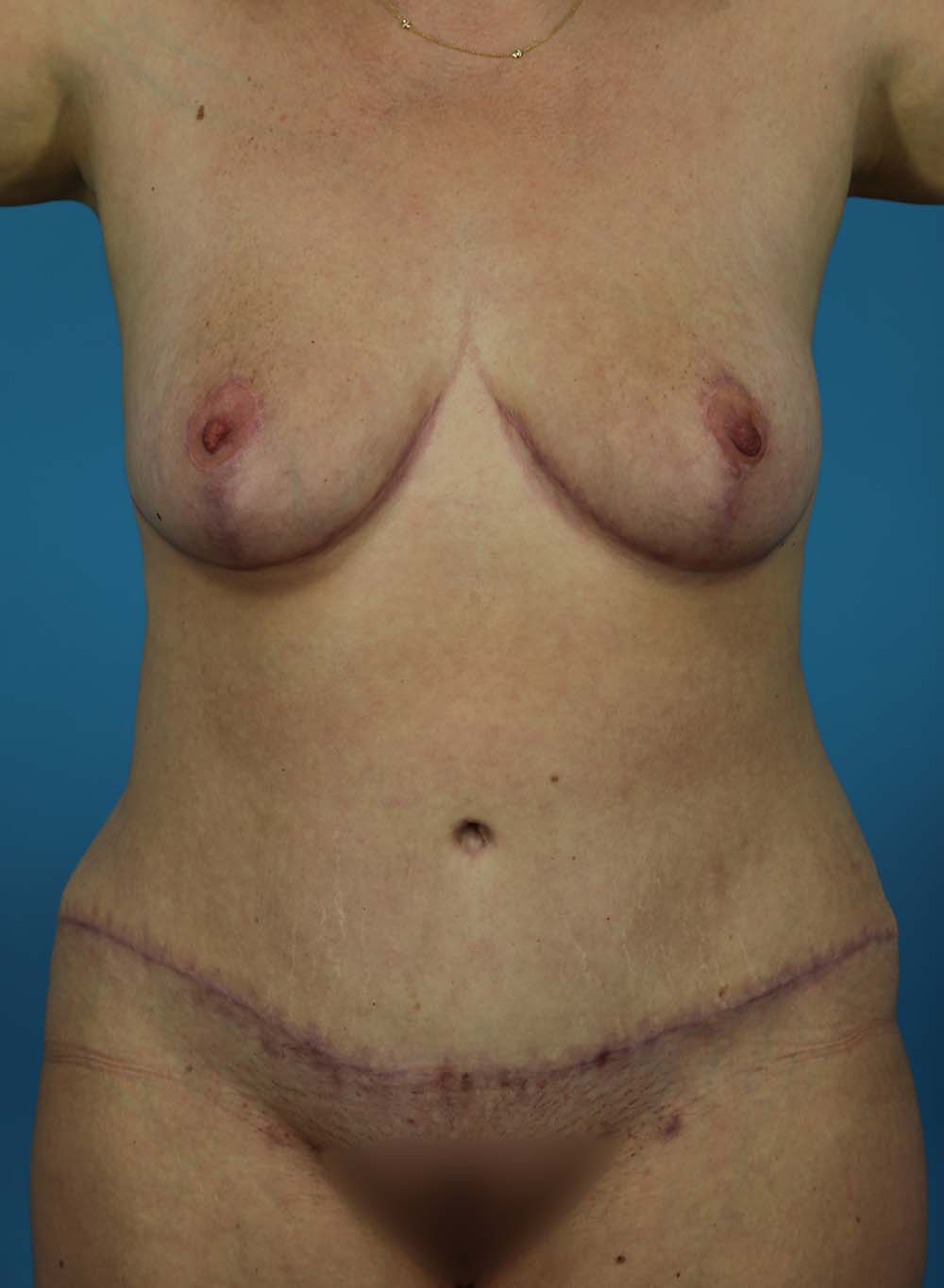 Liposuction Before and After | Dr Evan W Beale