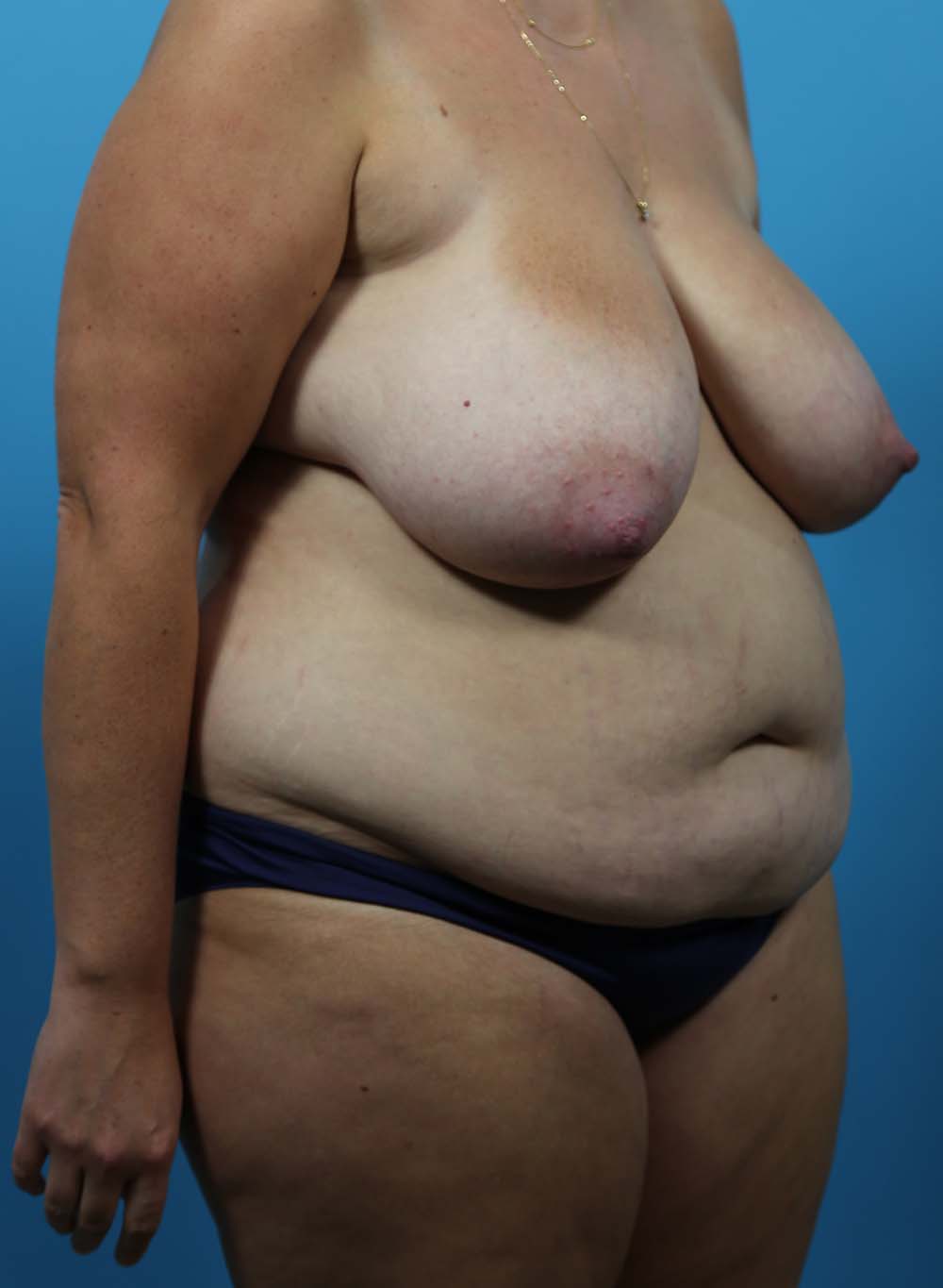 Liposuction Before and After | Dr Evan W Beale