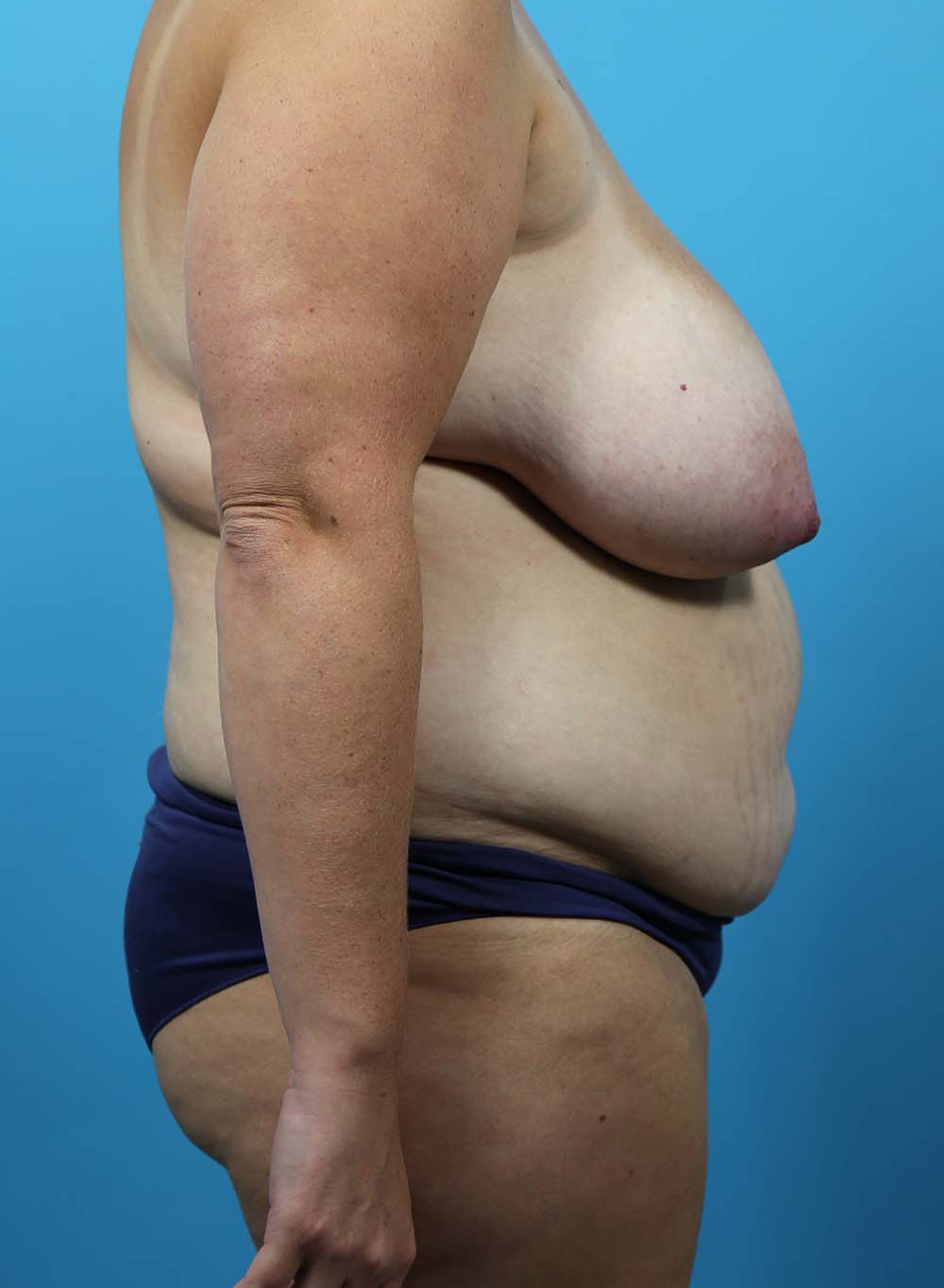 Liposuction Before and After | Dr Evan W Beale