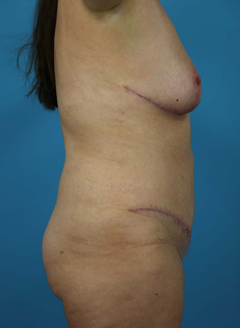 Liposuction Before and After | Dr Evan W Beale