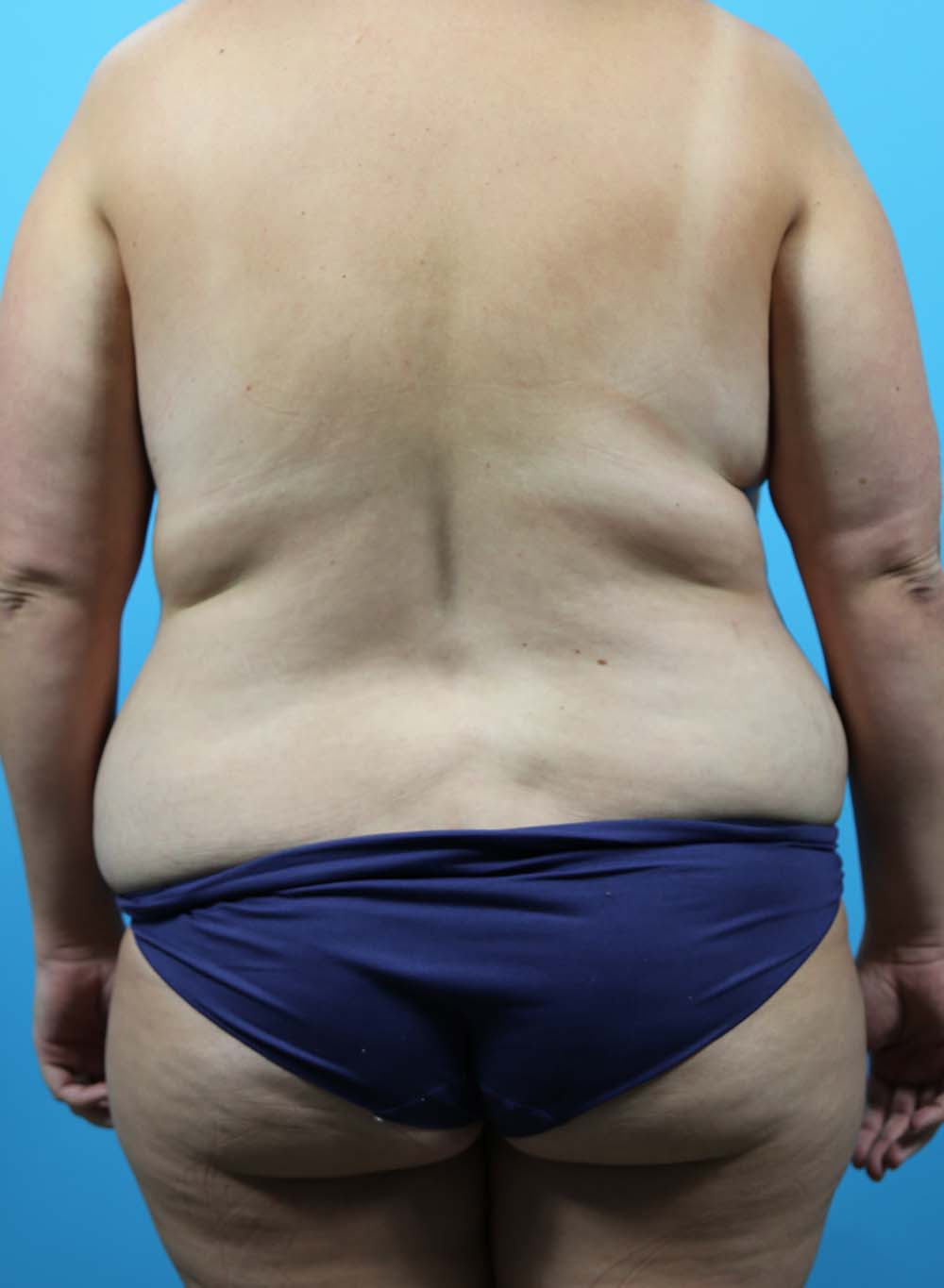 Liposuction Before and After | Dr Evan W Beale