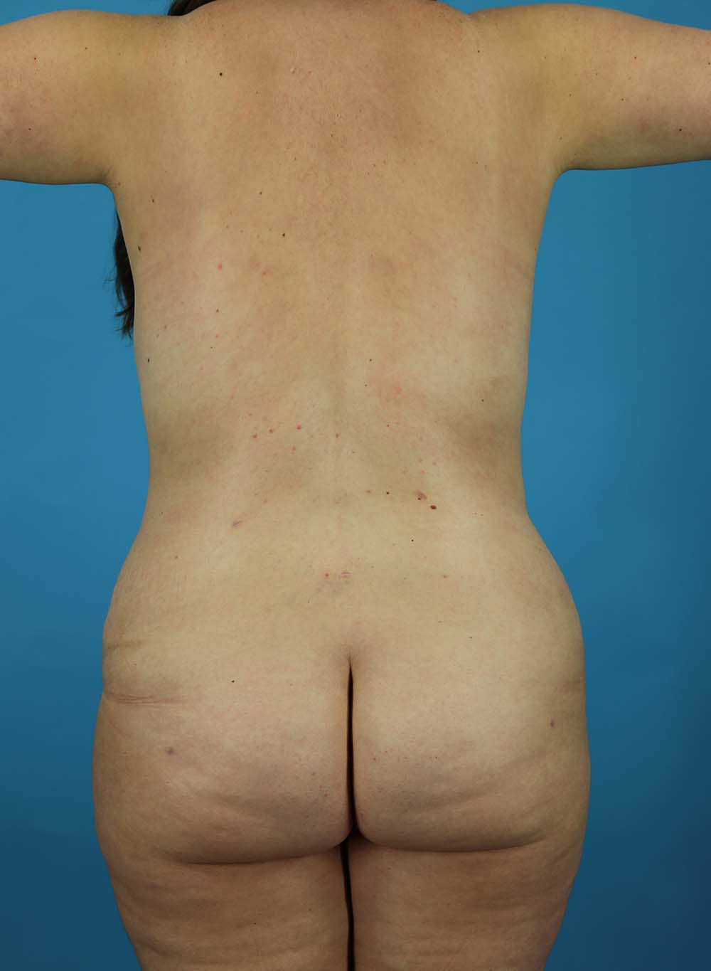 Liposuction Before and After | Dr Evan W Beale
