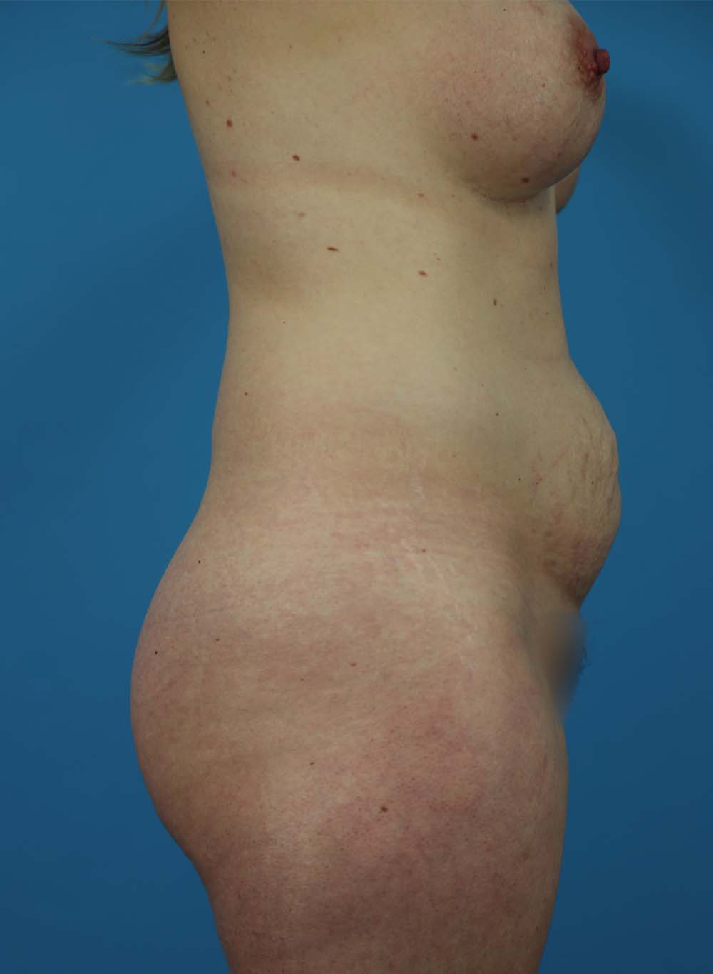 Liposuction Before and After | Dr Evan W Beale