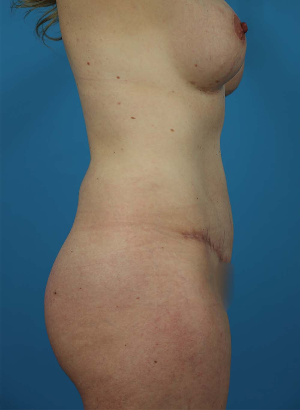 Liposuction Before and After | Dr Evan W Beale