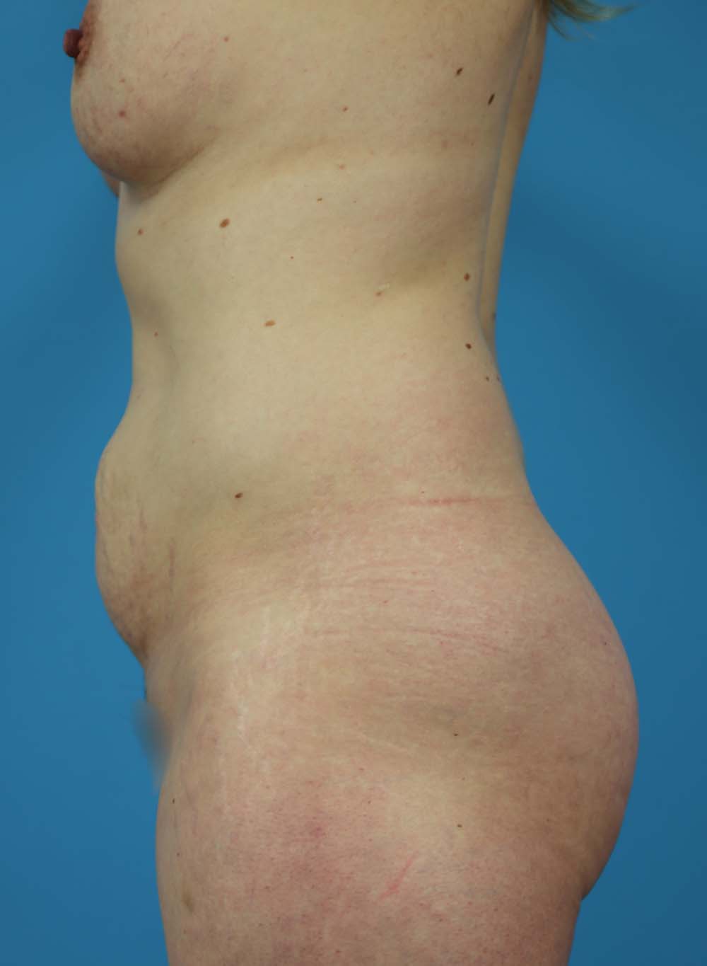 Liposuction Before and After | Dr Evan W Beale
