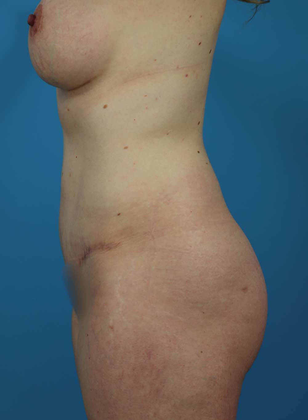 Liposuction Before and After | Dr Evan W Beale