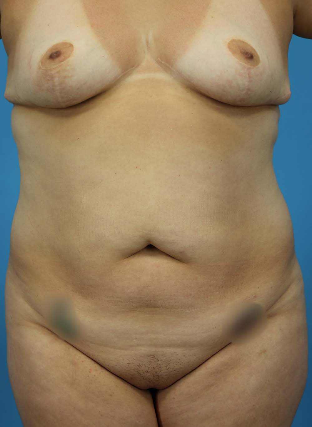 Liposuction Before and After | Dr Evan W Beale