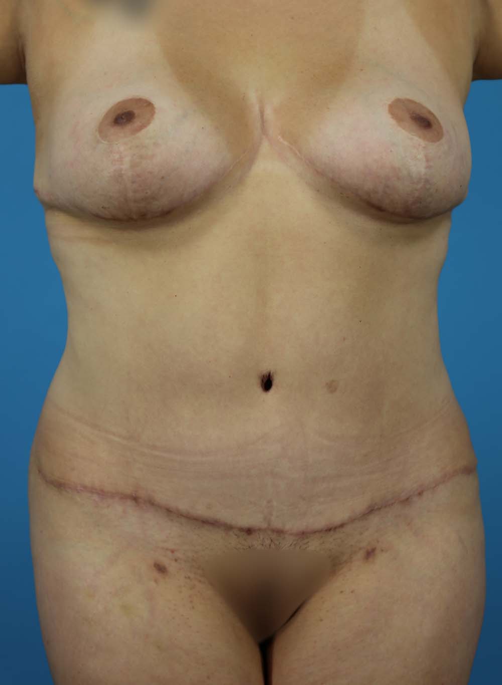 Liposuction Before and After | Dr Evan W Beale