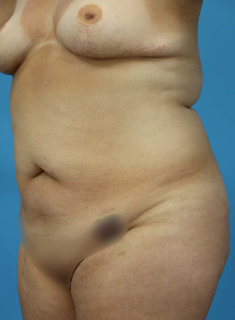 Liposuction Before and After | Dr Evan W Beale