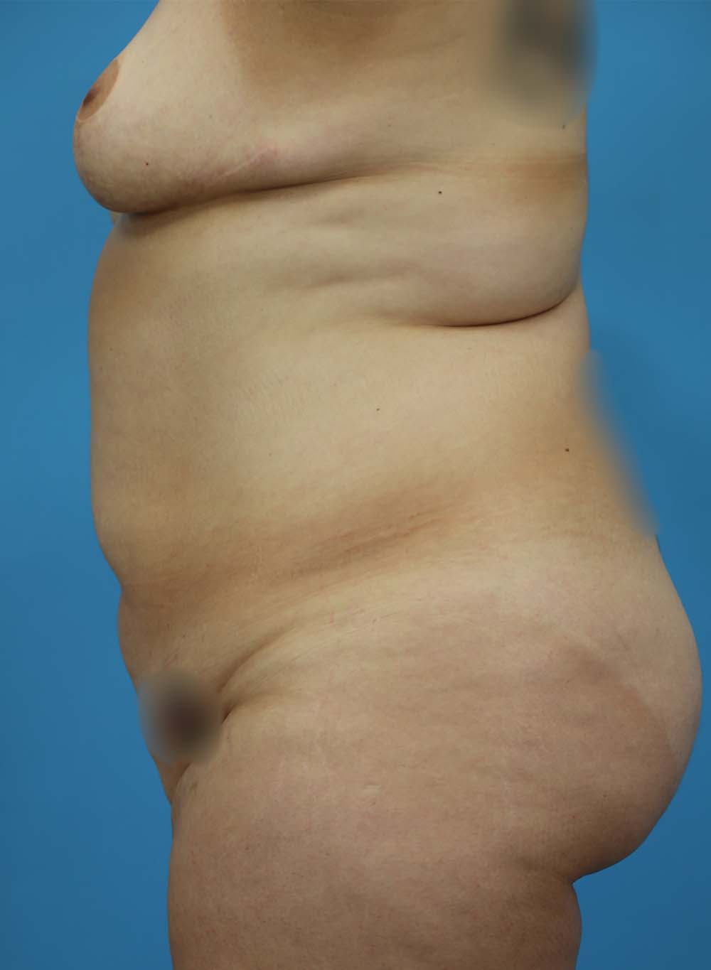 Liposuction Before and After | Dr Evan W Beale