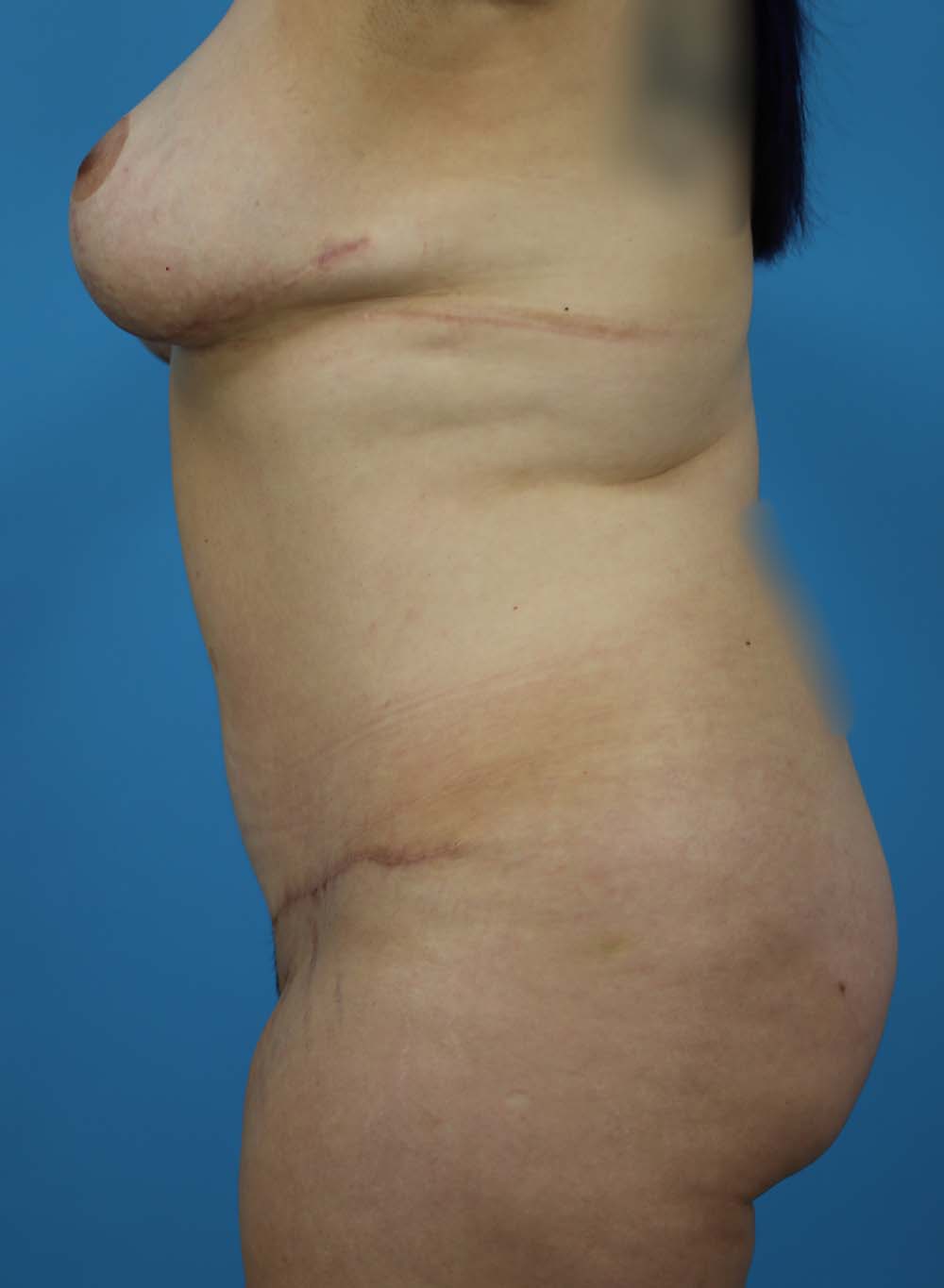 Liposuction Before and After | Dr Evan W Beale