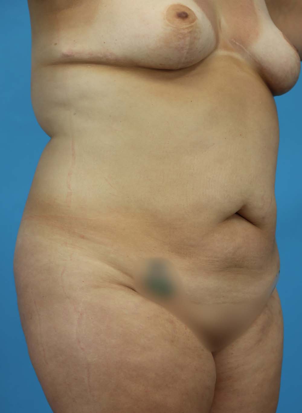Liposuction Before and After | Dr Evan W Beale