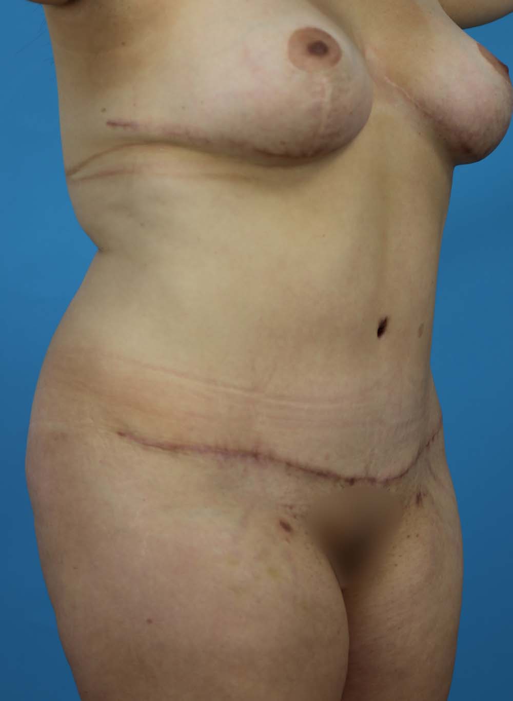 Liposuction Before and After | Dr Evan W Beale