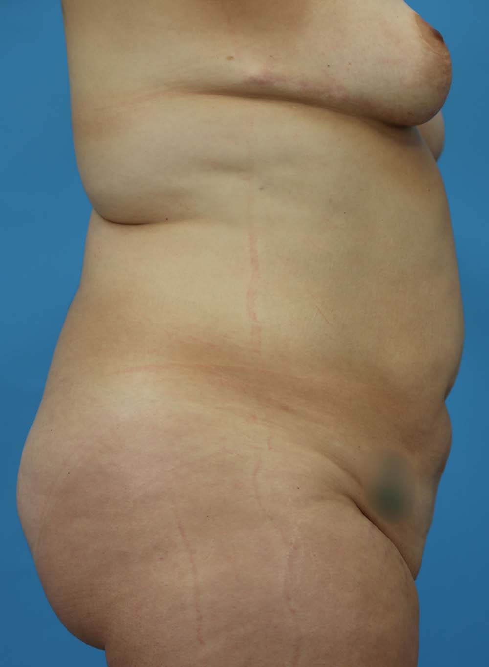 Liposuction Before and After | Dr Evan W Beale