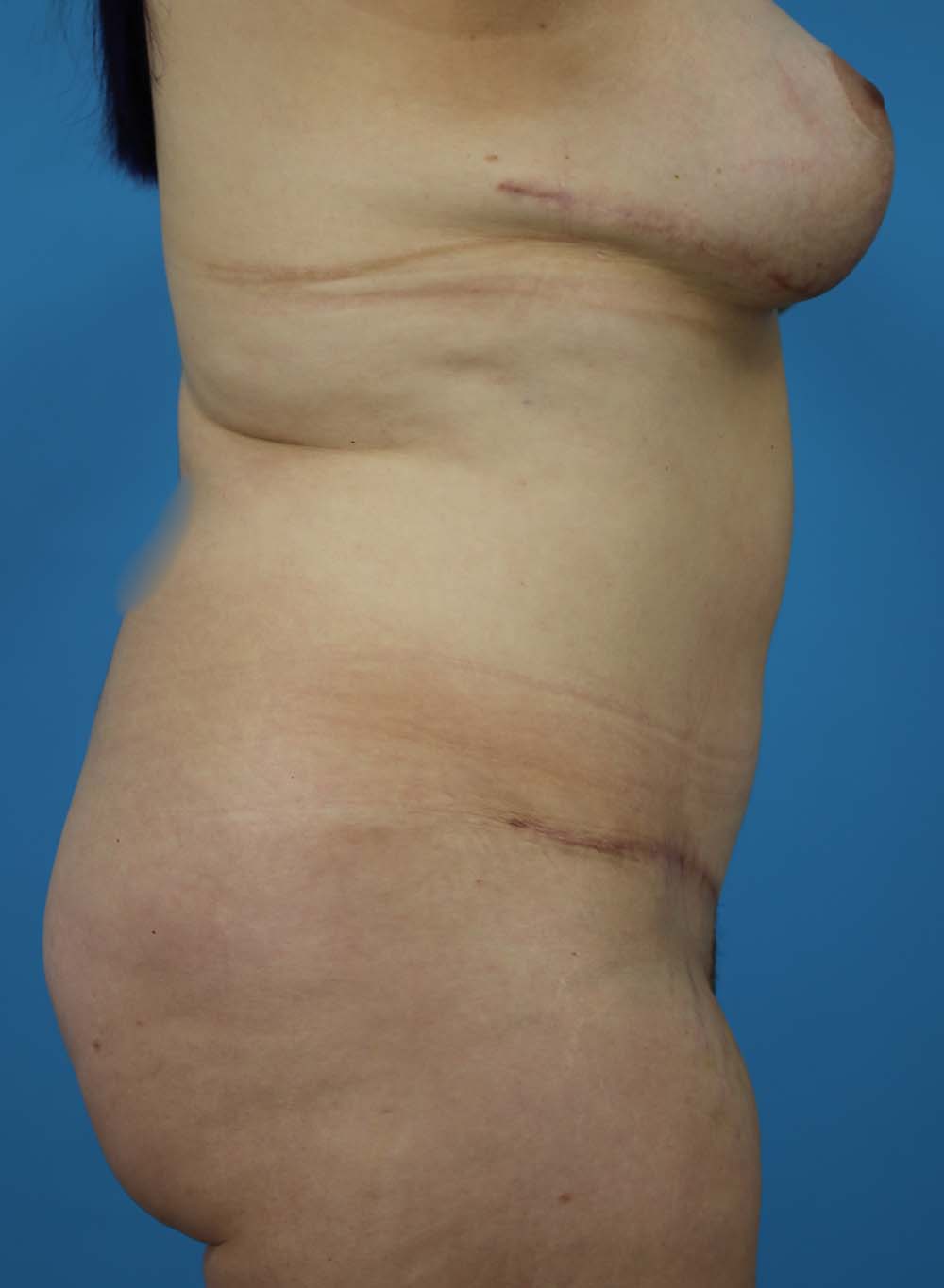 Liposuction Before and After | Dr Evan W Beale