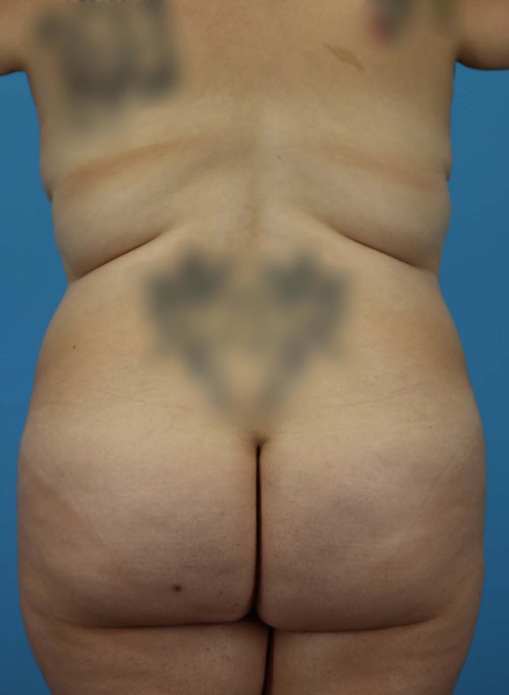 Liposuction Before and After | Dr Evan W Beale