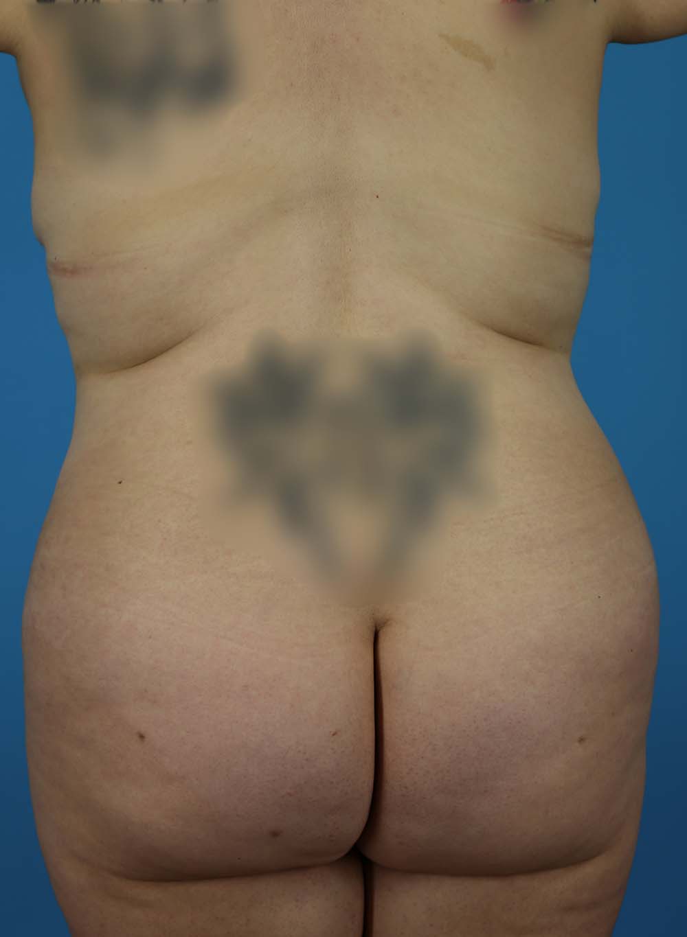 Liposuction Before and After | Dr Evan W Beale