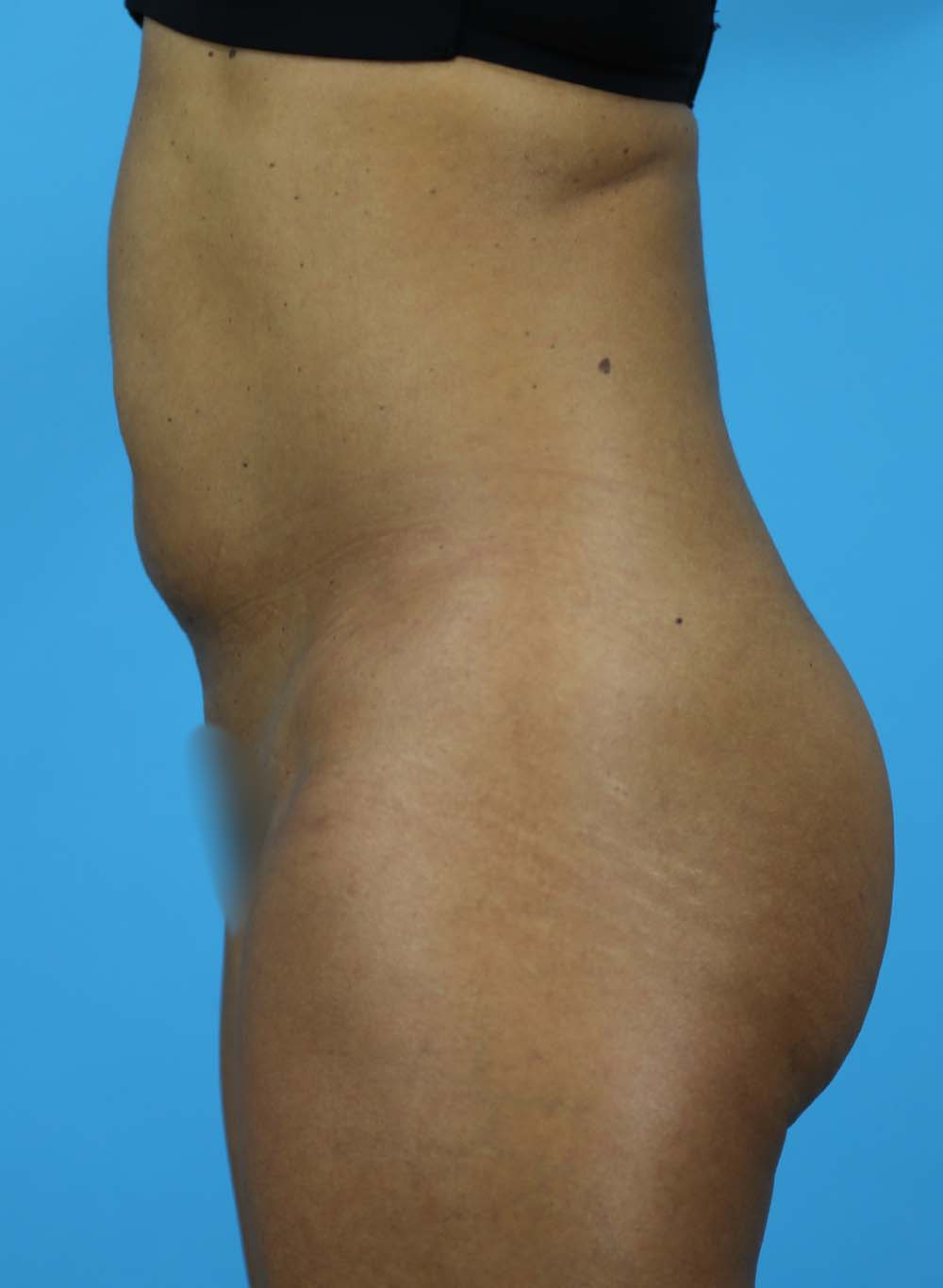 Liposuction Before and After | Dr Evan W Beale