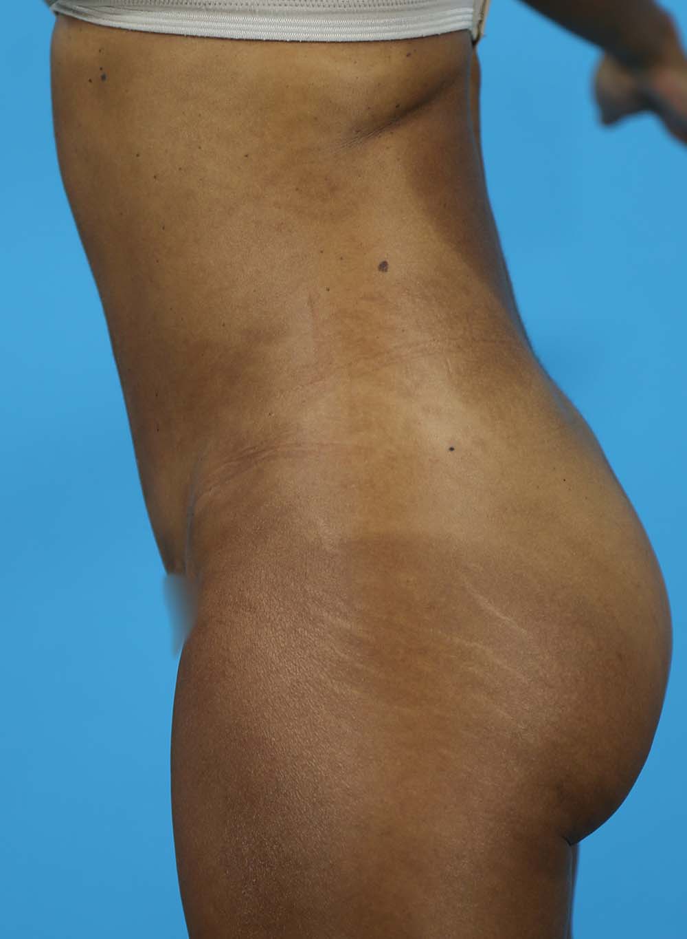 Liposuction Before and After | Dr Evan W Beale