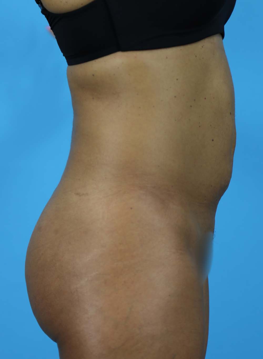 Liposuction Before and After | Dr Evan W Beale