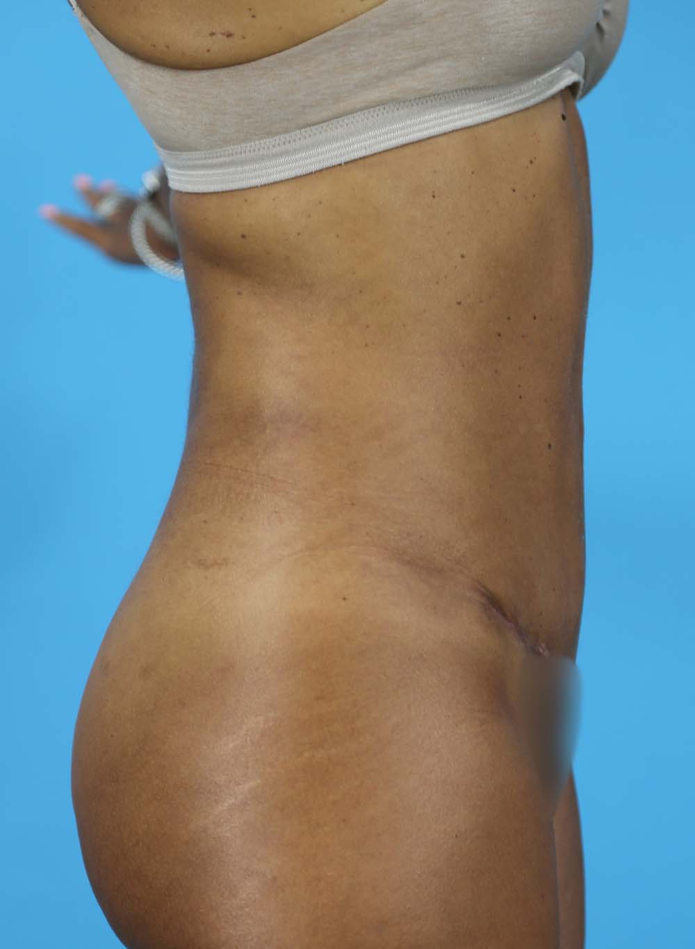 Liposuction Before and After | Dr Evan W Beale