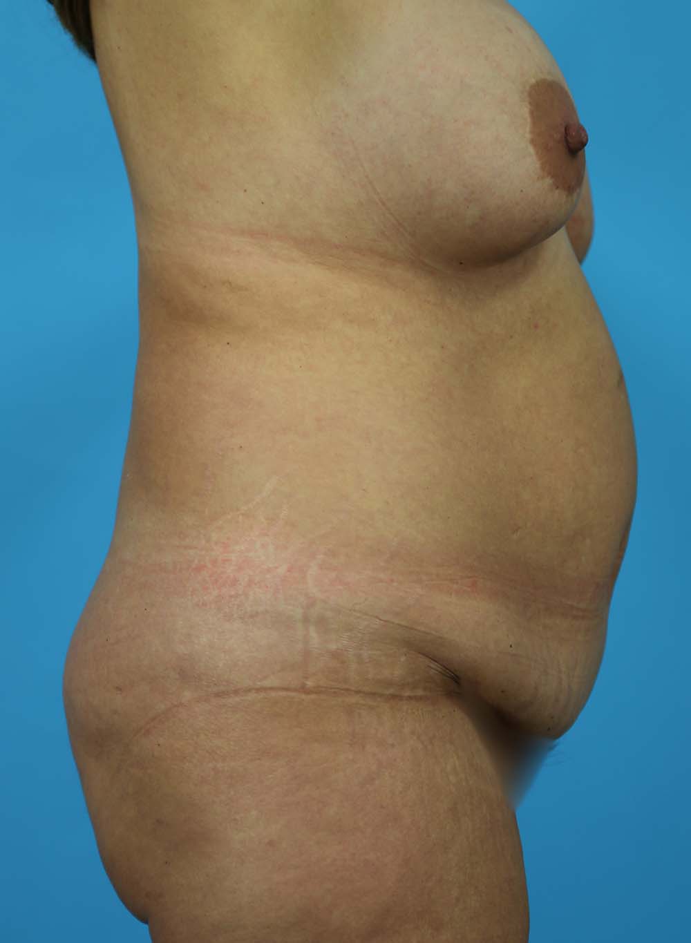Liposuction Before and After | Dr Evan W Beale