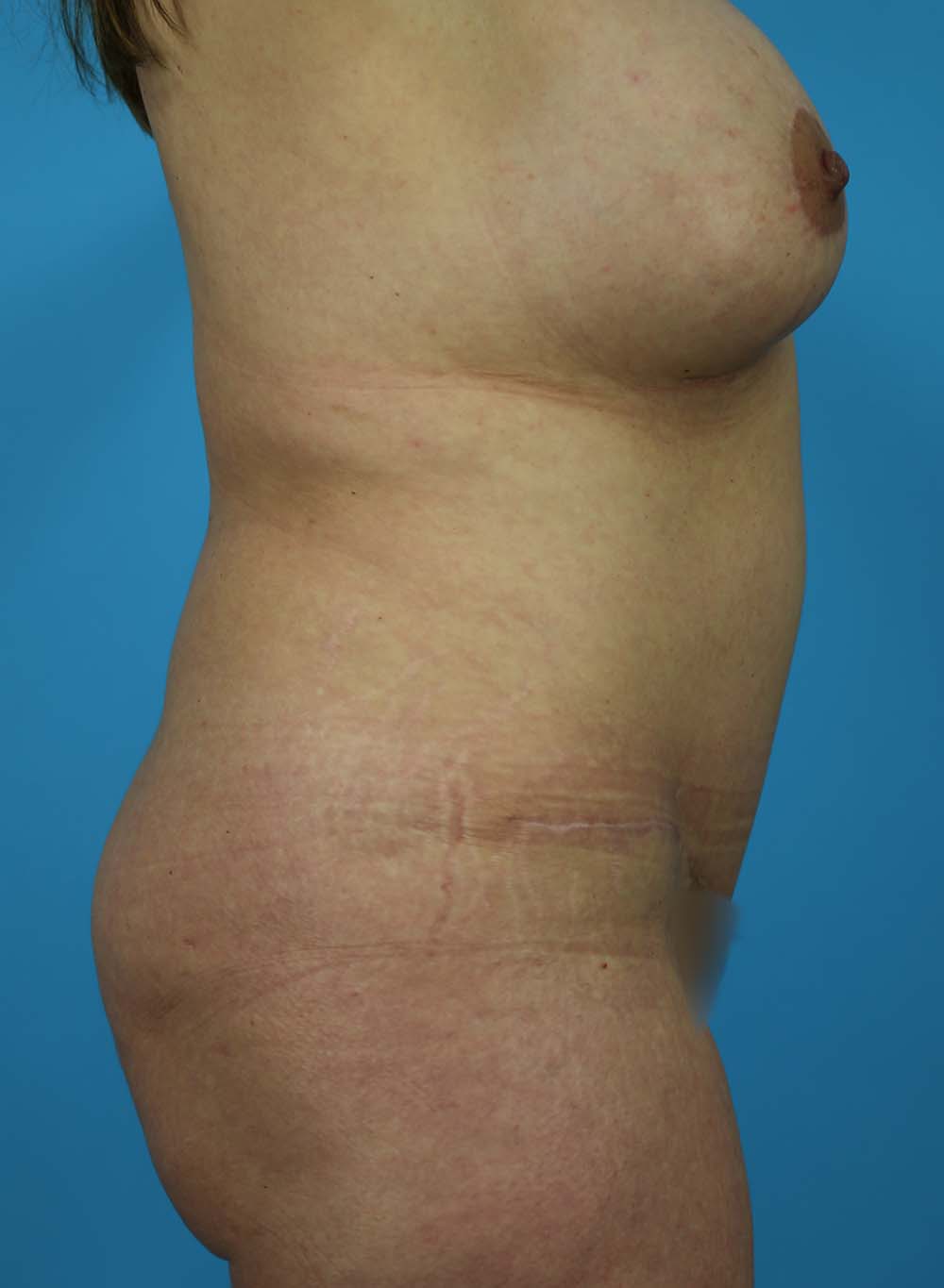 Liposuction Before and After | Dr Evan W Beale