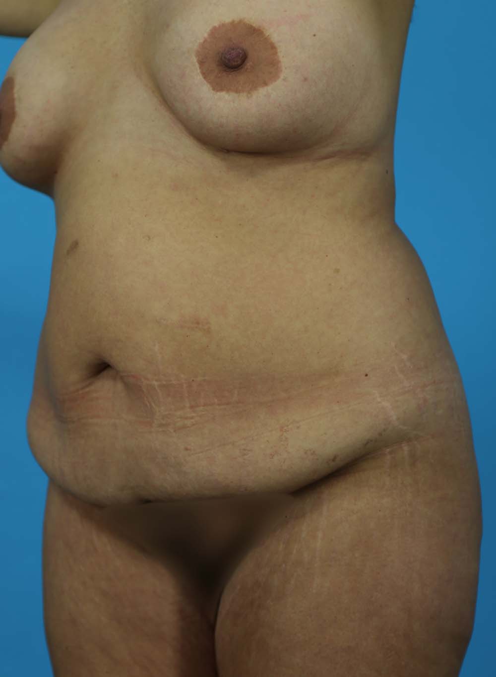 Liposuction Before and After | Dr Evan W Beale