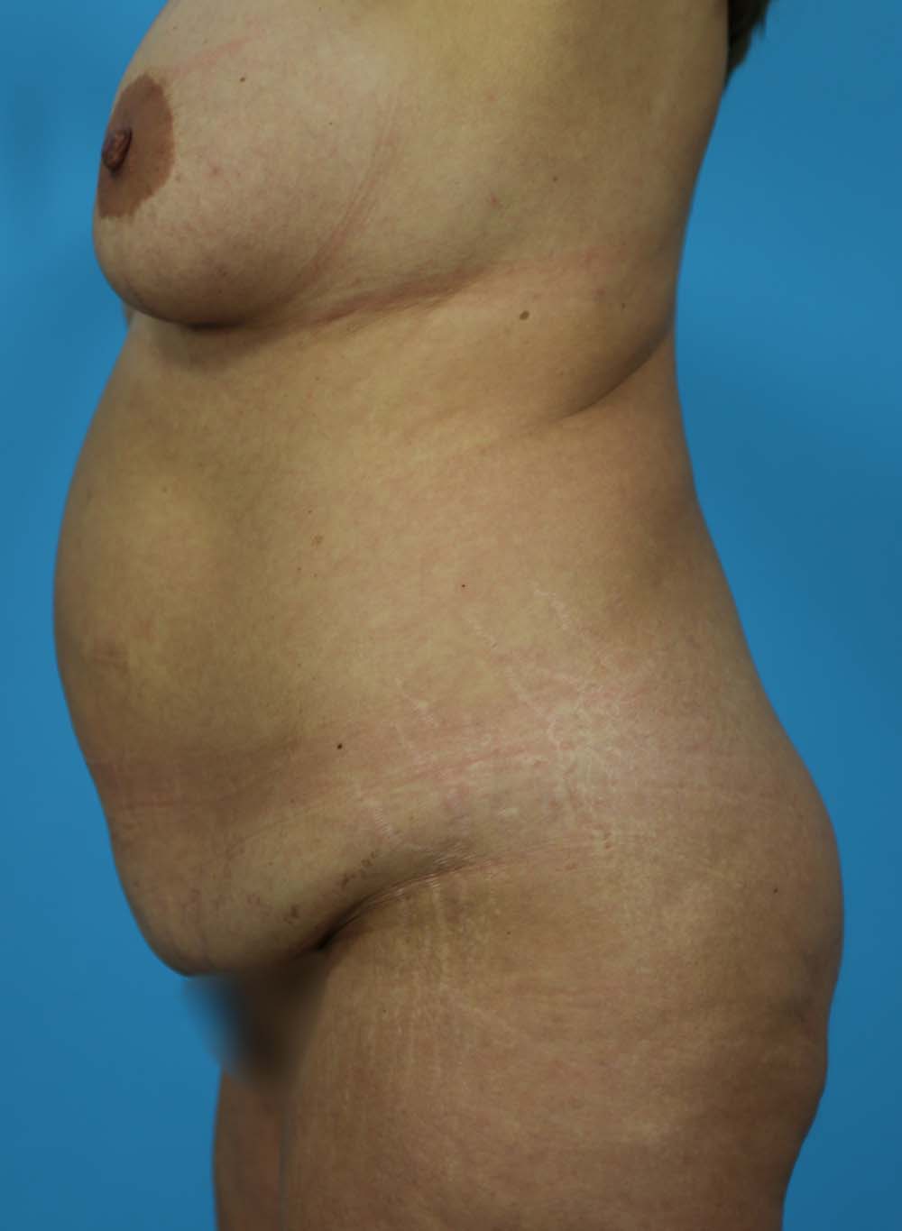 Liposuction Before and After | Dr Evan W Beale