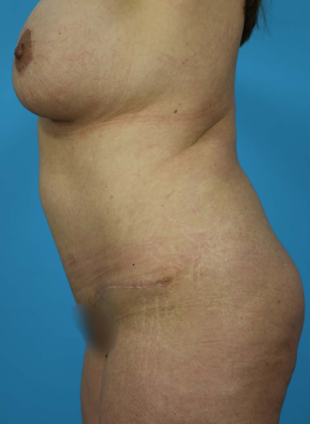 Liposuction Before and After | Dr Evan W Beale